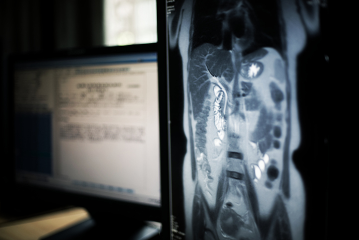 Photo shows MRI image of abdomen on a medical monitor/Getty Images