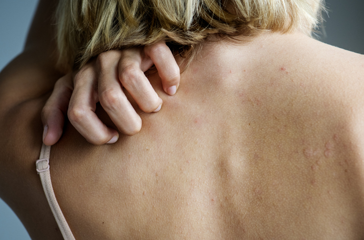 Photo shows woman scratching itchy skin/Getty Images