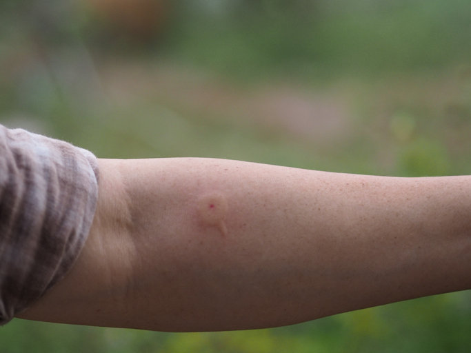 Photo shows the arm of a woman who was stung by a wasp/Getty Images