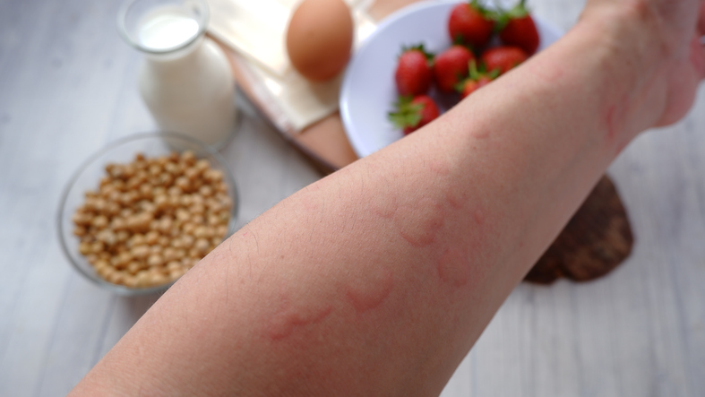 Close up image of arm suffering severe urticaria or hives/Getty Images